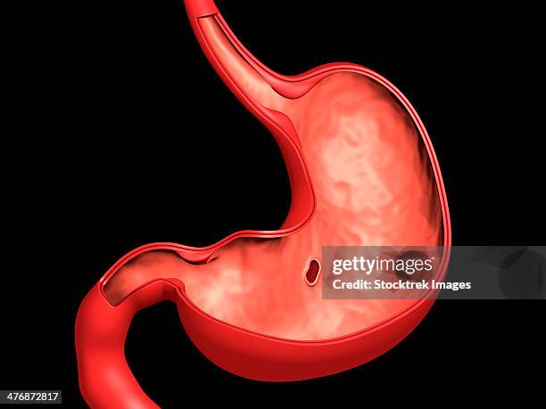 ilustraciones, imágenes clip art, dibujos animados e iconos de stock de conceptual image of peptic ulcer in human stomach. - gangrena