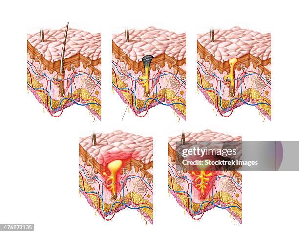 ilustraciones, imágenes clip art, dibujos animados e iconos de stock de different types of acne, non-inflammatory and inflammatory. - acné