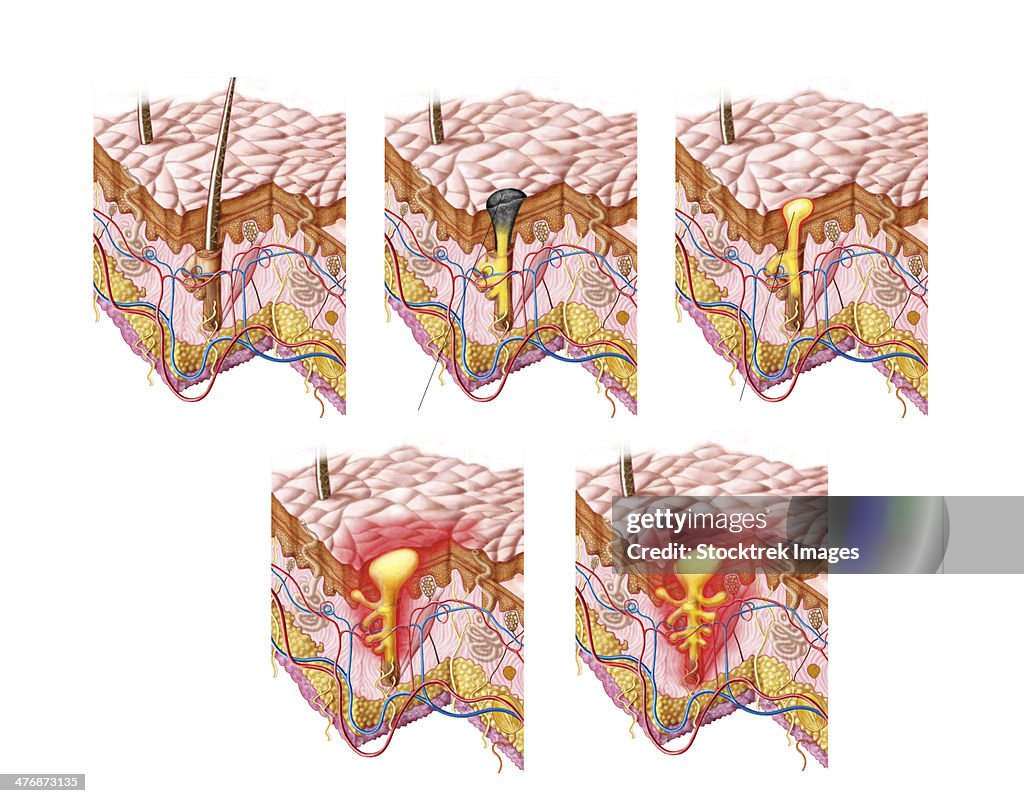 Different types of acne, non-inflammatory and inflammatory.