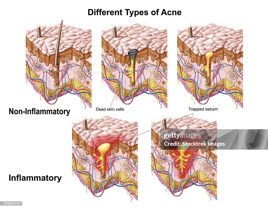 Different types of acne, non-inflammatory and inflammatory.