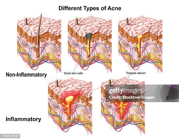 different types of acne, non-inflammatory and inflammatory. - sebaceous gland stock illustrations