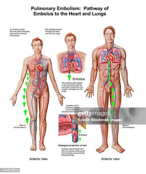 pulmonary embolism, pathway of embolus to the heart and lungs. - human head veins stock illustrations