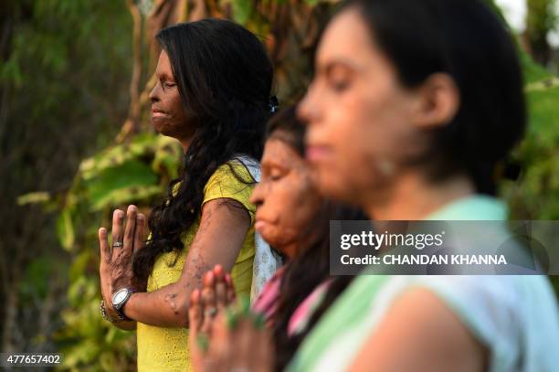 To go with story 'India-lifestyle-yoga-government' by Annie BANERJI In this photograph taken on June 14 Indian acid attack survivors, 20 year-old,...