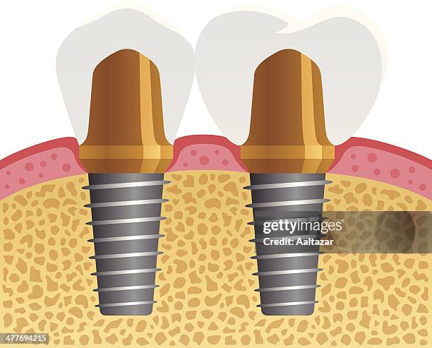 dental implants - skull vector side stock illustrations