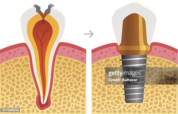 ilustrações, clipart, desenhos animados e ícones de cárie dentária com implante fixa - abcesso