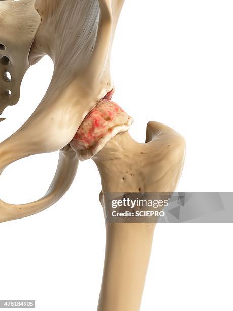 arthritic hip, artwork - hip anatomy illustration stock illustrations