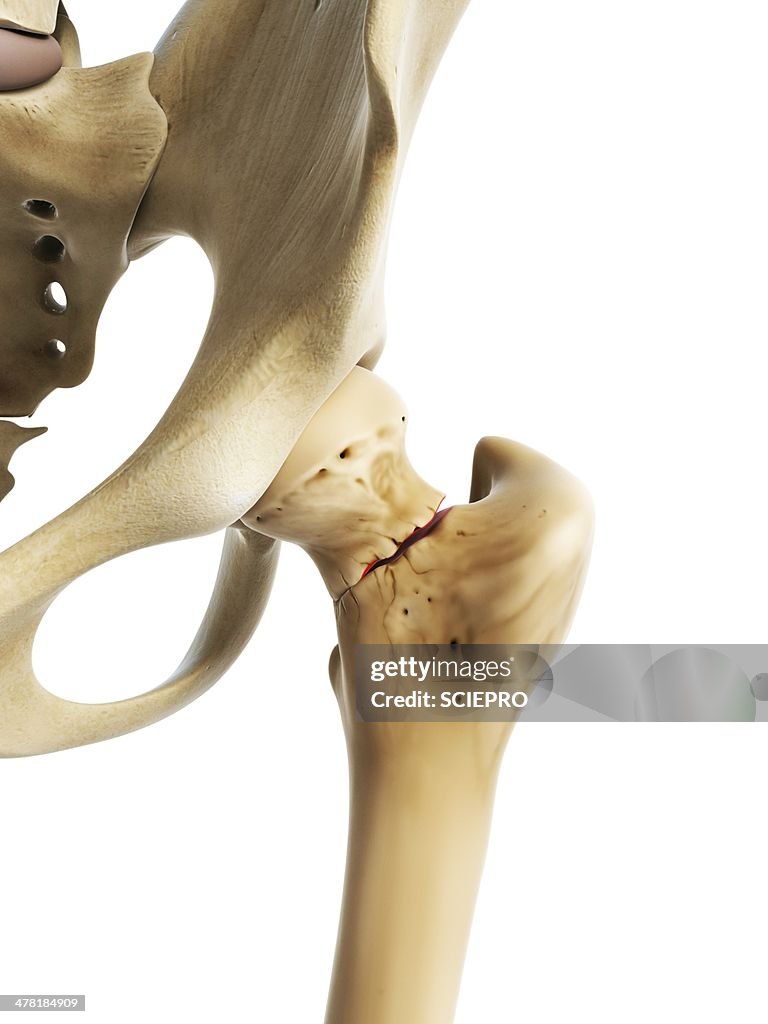 Hip fracture, artwork