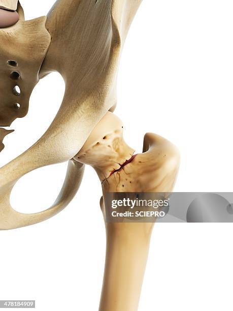 hip fracture, artwork - hips stock illustrations