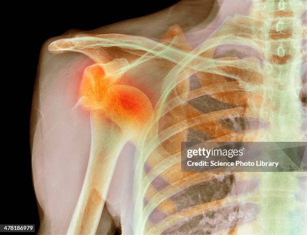 dislocated shoulder, x-ray - shoulder bone stock pictures, royalty-free photos & images