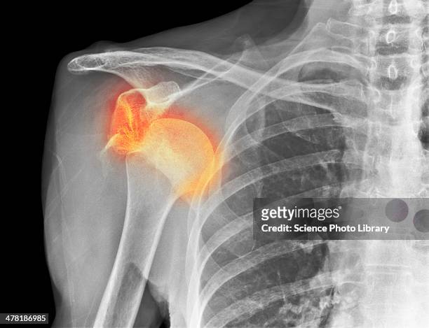 dislocated shoulder, x-ray - shoulder bone stock pictures, royalty-free photos & images