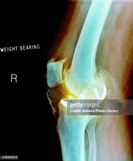 osteoarthritis of the knee, x-ray - osteoarthritis stock pictures, royalty-free photos & images