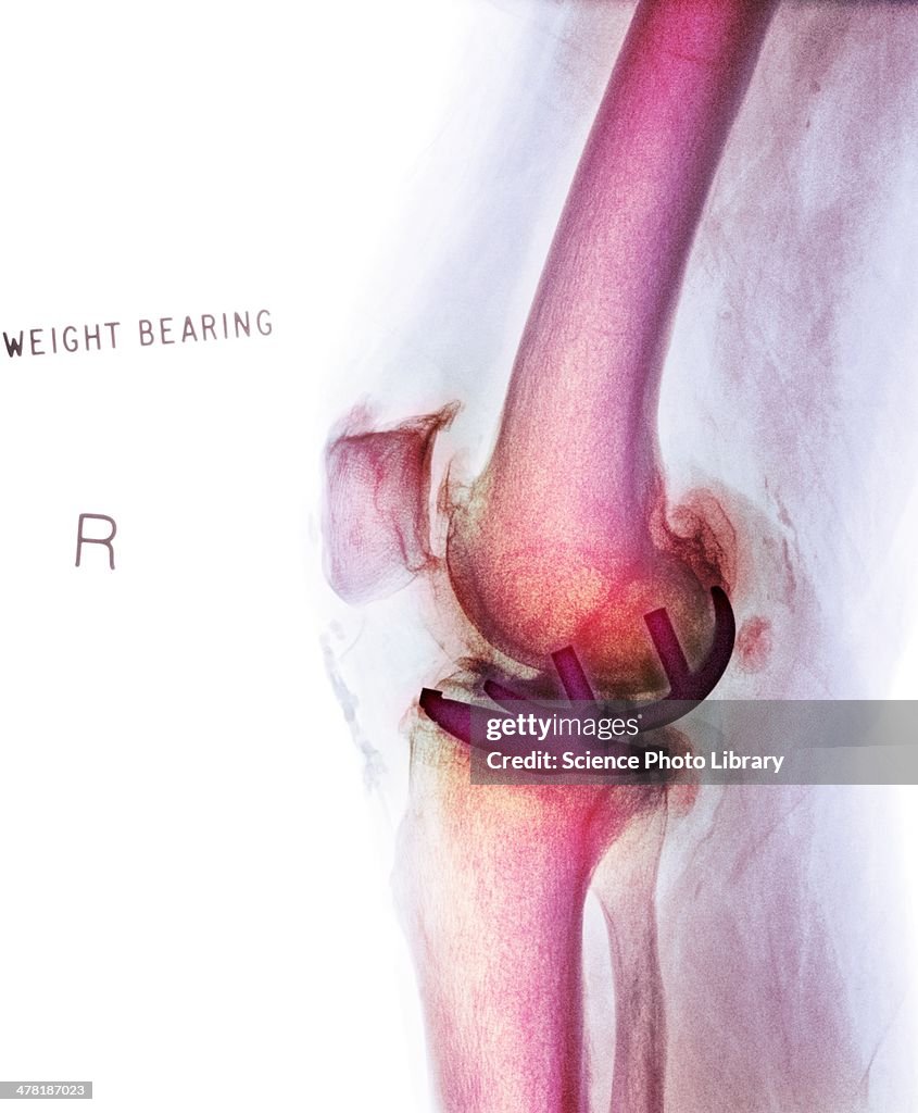 Osteoarthritis of the knee, X-ray