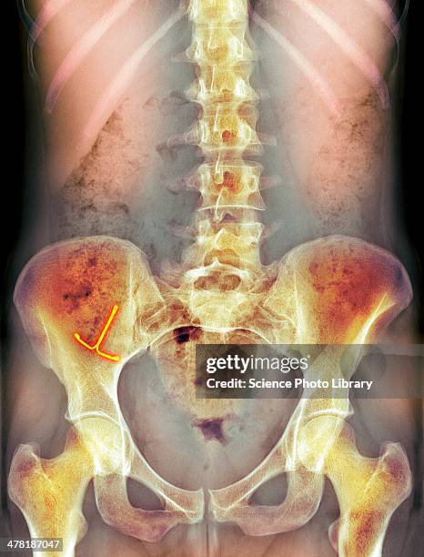 ectopic iud contraceptive, x-ray - iud stock pictures, royalty-free photos & images