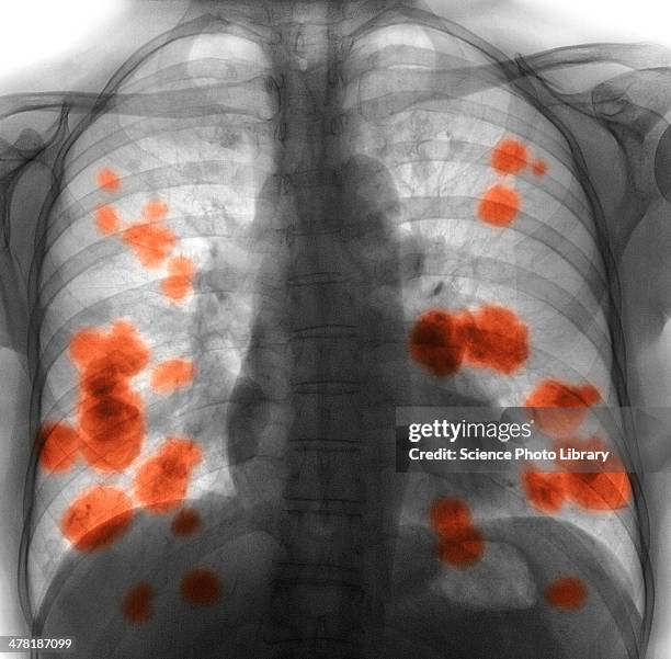 secondary lung cancer, x-ray - tumore metastatico foto e immagini stock