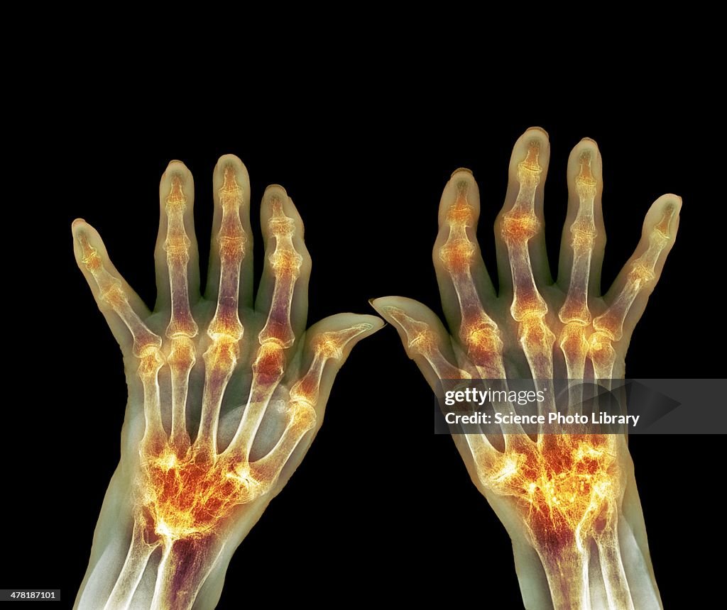 Rheumatoid arthritis, X-ray