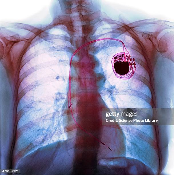 Foto Pacemaker Pacemaker Concept Fotografías e imágenes de stock - Getty Images