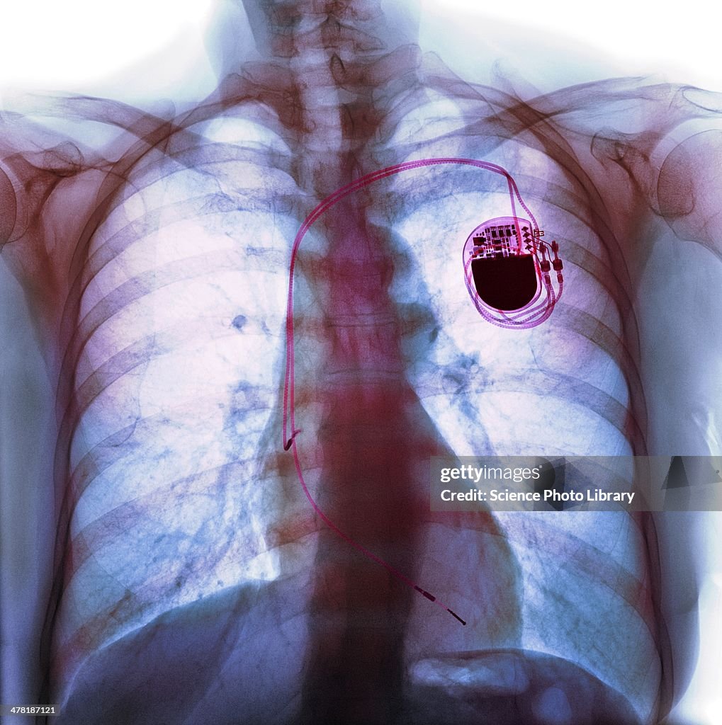 Dual chamber pacemaker, X-ray