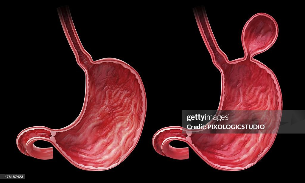 Human stomach with hernia, artwork