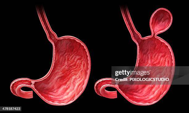human stomach with hernia, artwork - abdominal hernia stock illustrations