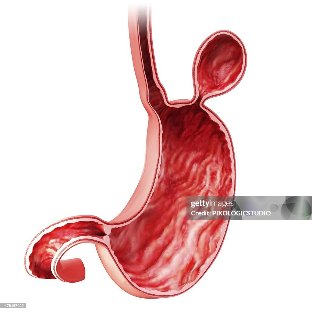 Human stomach with hernia, artwork