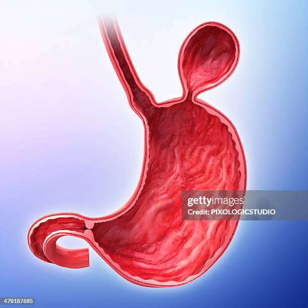 ilustraciones, imágenes clip art, dibujos animados e iconos de stock de human stomach with hernia, artwork - hernia de hiato
