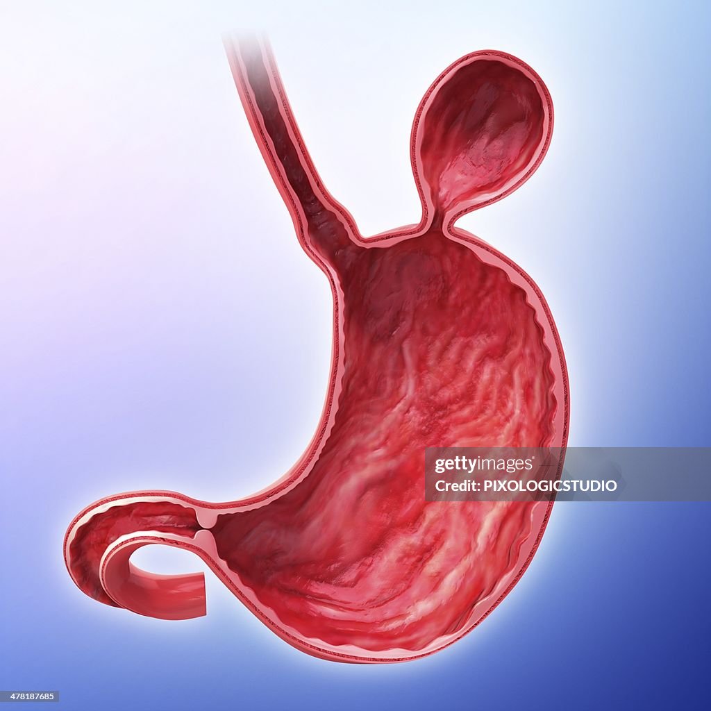 Human stomach with hernia, artwork