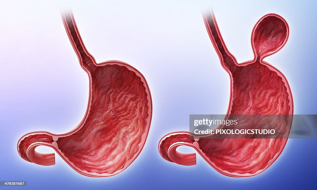 Human stomach with hernia, artwork