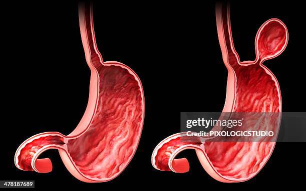 illustrations, cliparts, dessins animés et icônes de human stomach with hernia, artwork - sphincter