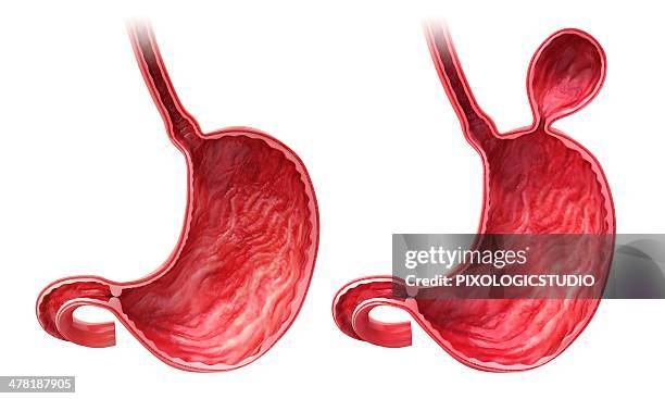 ilustraciones, imágenes clip art, dibujos animados e iconos de stock de human stomach with hernia, artwork - hernia de hiato