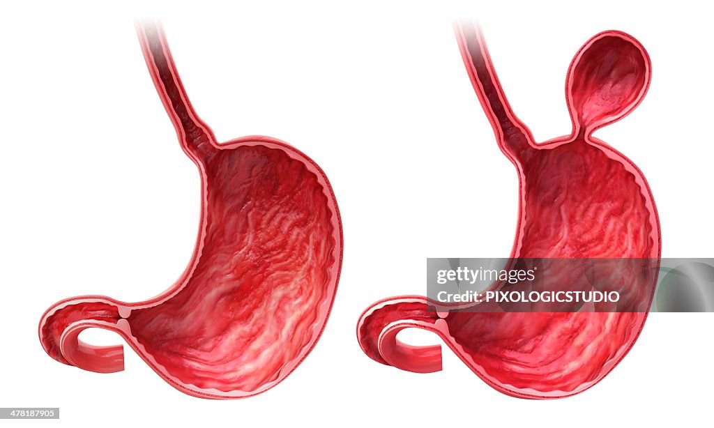 Human stomach with hernia, artwork