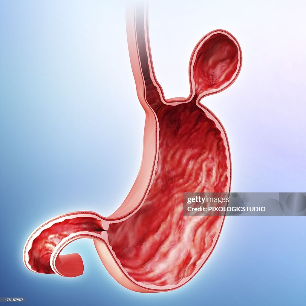 Human stomach with hernia, artwork