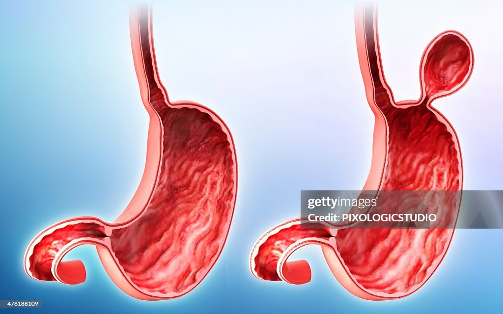 Human stomach with hernia, artwork