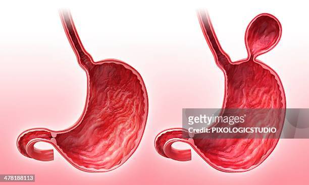 human stomach with hernia, artwork - heartburn stock illustrations