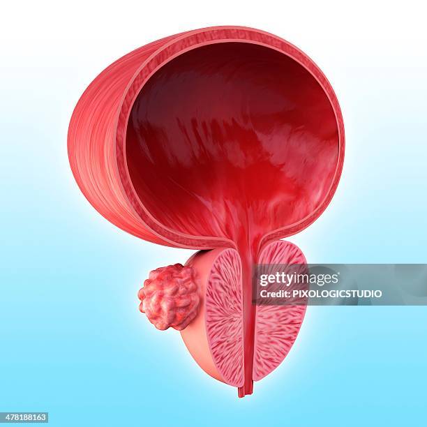 stockillustraties, clipart, cartoons en iconen met prostate gland tumour, artwork - opengewerkte tekening