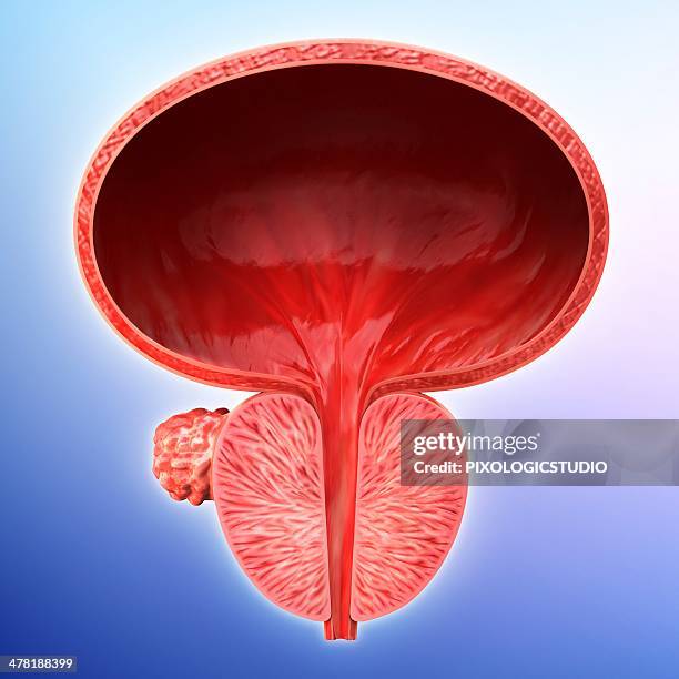 prostate gland tumour, artwork - human body part stock illustrations