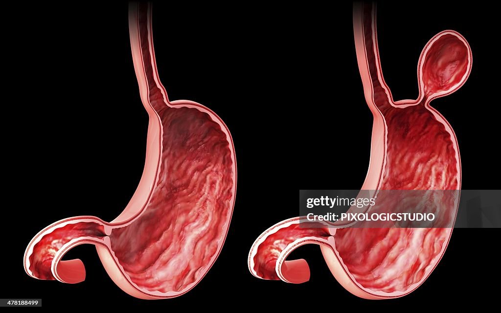 Human stomach with hernia, artwork