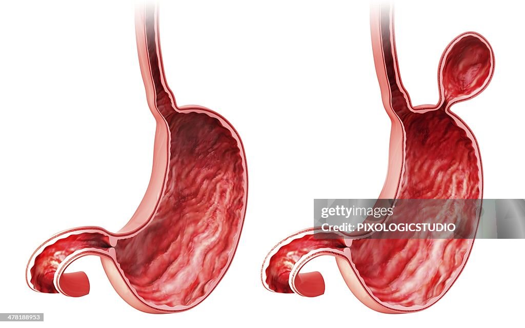 Human stomach with hernia, artwork