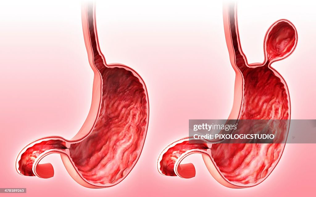 Human stomach with hernia, artwork