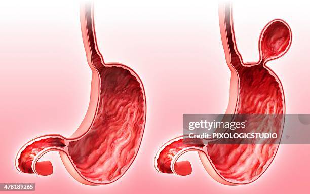 human stomach with hernia, artwork - abdominal hernia stock illustrations