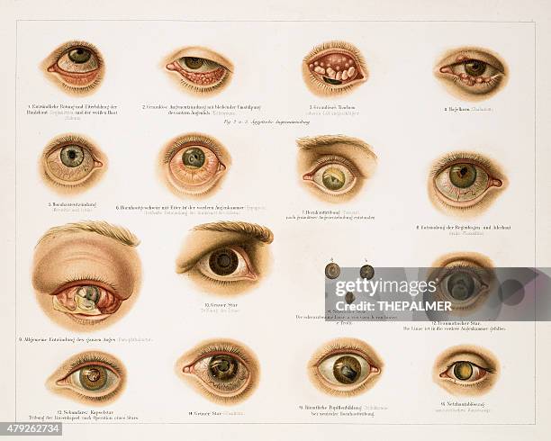 Human Eye Disoder Human Eye Diseases Lithograph 1896 High-Res Vector Graphic - Getty Images