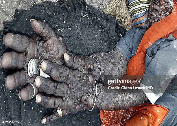 Lady with Neurofibromatosis lays on the pavement with hands out begging hands hold change tumors are all over her skin MYSORE INDIA