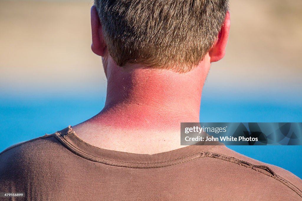 Red sunburnt neck from too much sun. Australia.