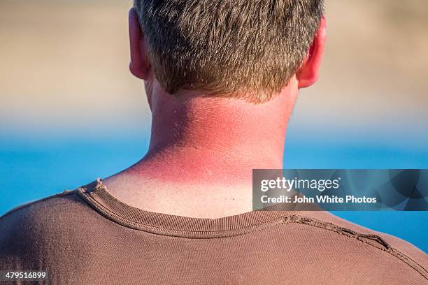 red sunburnt neck from too much sun. australia. - sunburned stock pictures, royalty-free photos & images