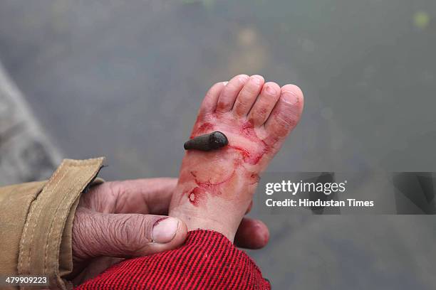 Leeches suck blood on the feet of a patient during a leech therapy session on a shallow side of a lake on March 21, 2014 in Srinagar, India. Nauroz,...