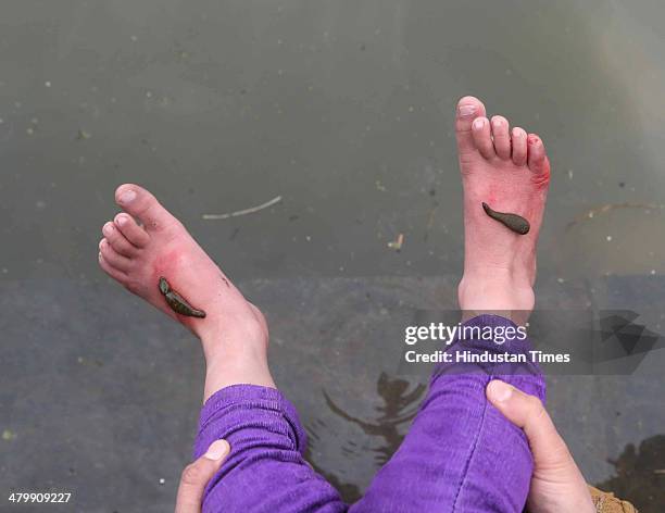 Leeches suck blood on the feet of a patient during a leech therapy session on a shallow side of a lake on March 21, 2014 in Srinagar, India. Nauroz,...