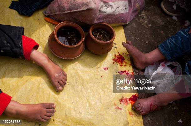 Kashmiri children receive leech therapy from practitioners on March 21 in Srinagar, the summer capital of Indian administered Kashmir, India. Nowruz,...