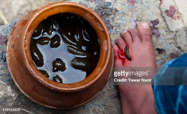 Kashmiri patient receives leech therapy on his foot on March 21 in Srinagar, the summer capital of Indian administered Kashmir, India. Nowruz, the...
