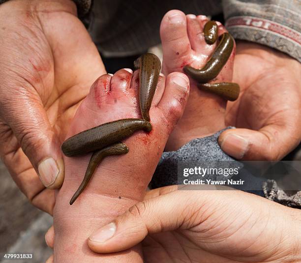 Young Kashmiri patient receives leech therapy on his feet on March 21 in Srinagar, the summer capital of Indian administered Kashmir, India. Nowruz,...