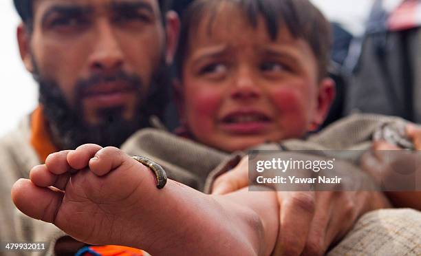 Young Kashmiri child patient cries as he receives leech therapy on his foot from a practitioner on March 21 in Srinagar, the summer capital of Indian...