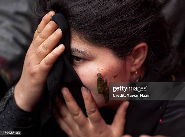 Kashmiri Muslim woman receives leech therapy from a practitioner on March 21 in Srinagar, the summer capital of Indian administered Kashmir, India....